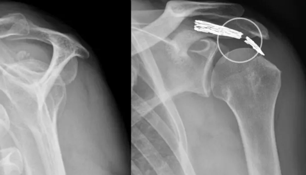 Rotatorenmanschette Behandlung Wien