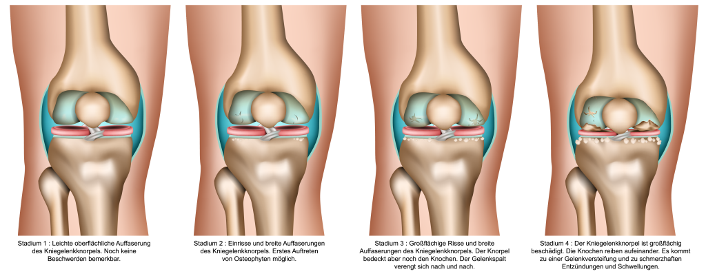 Hüftarthrose Coxarthrose Krankheitsverlauf